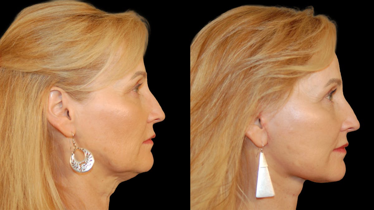 Neck Lift Before & After Gallery - Patient 234010 - Image 5