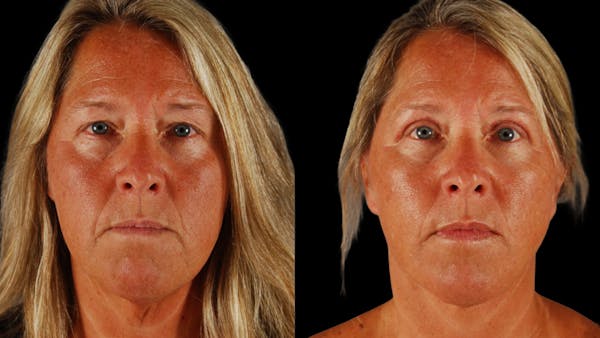 Neck Lift Before & After Gallery - Patient 101721 - Image 1
