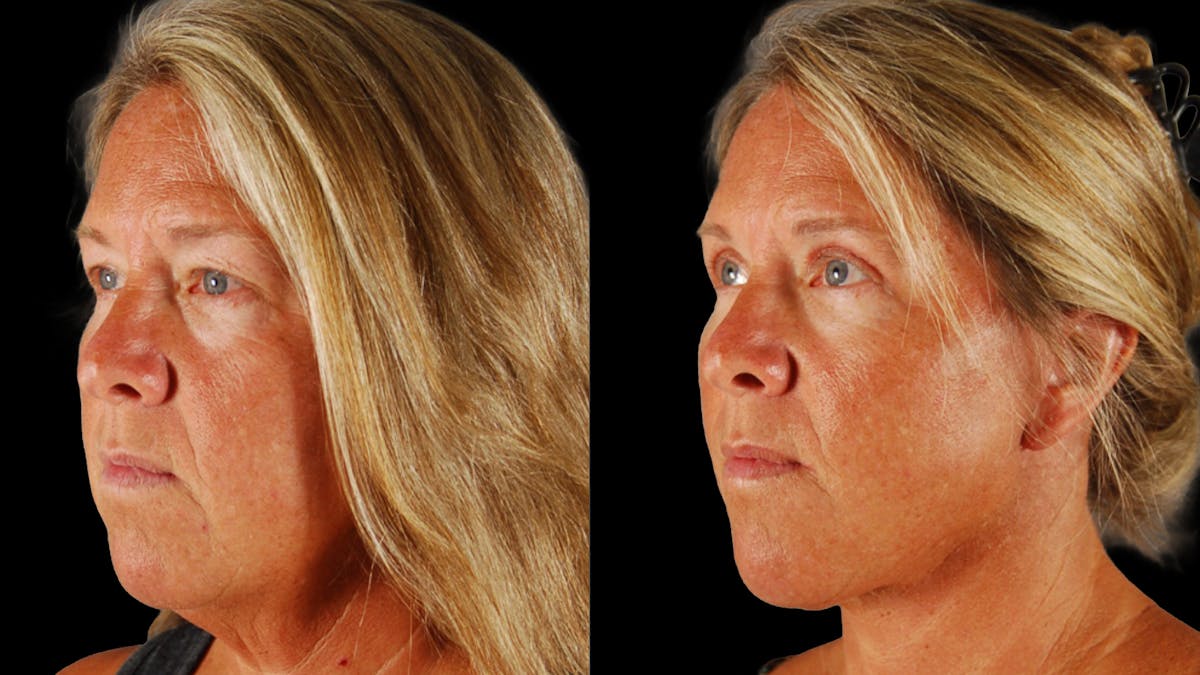 Deep Plane Facelift Before & After Gallery - Patient 727198 - Image 2