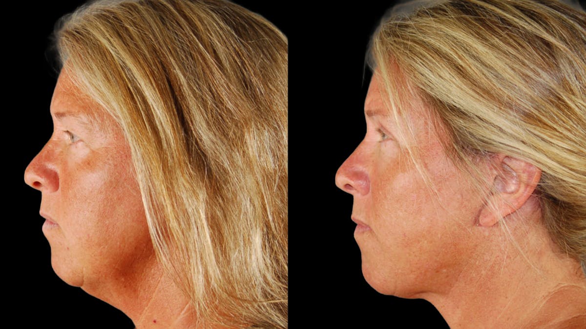 Deep Plane Facelift Before & After Gallery - Patient 727198 - Image 3