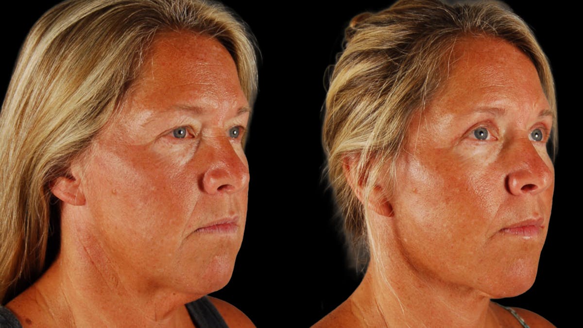 Deep Plane Facelift Before & After Gallery - Patient 727198 - Image 4