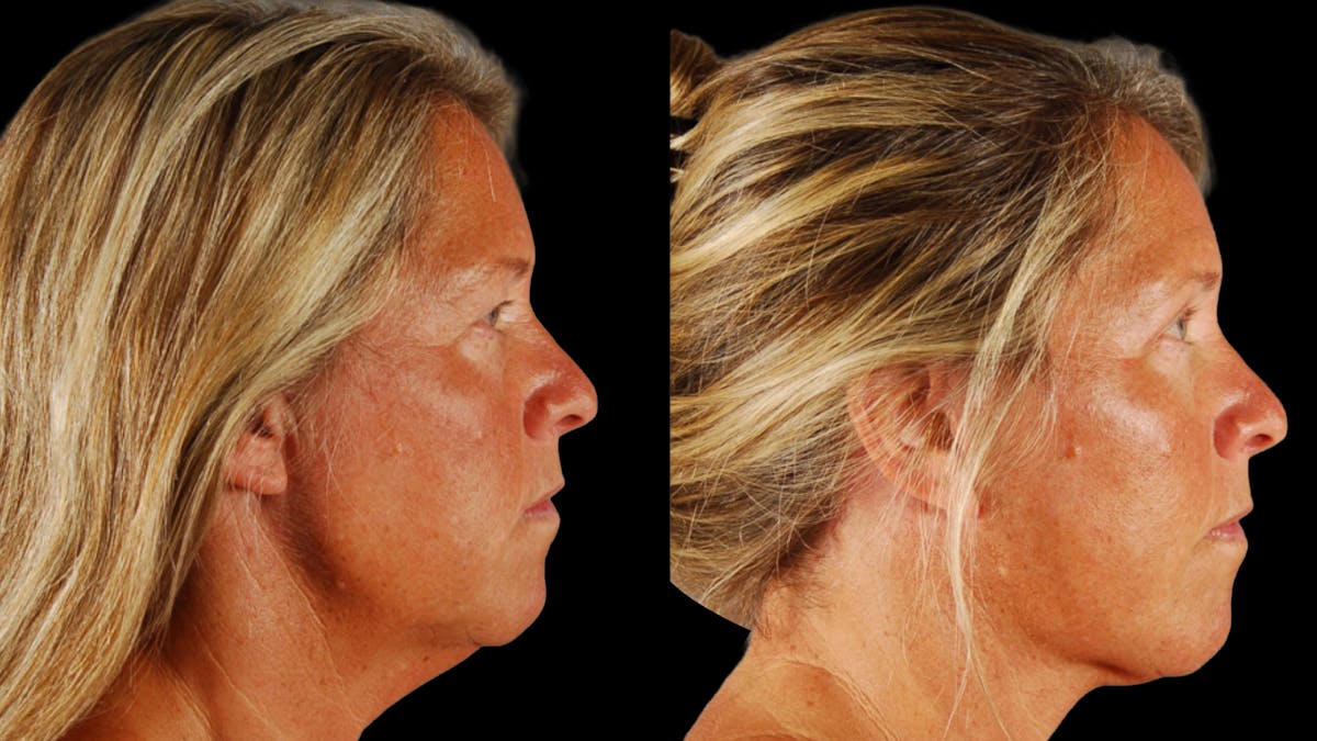 Deep Plane Facelift Before & After Gallery - Patient 727198 - Image 5