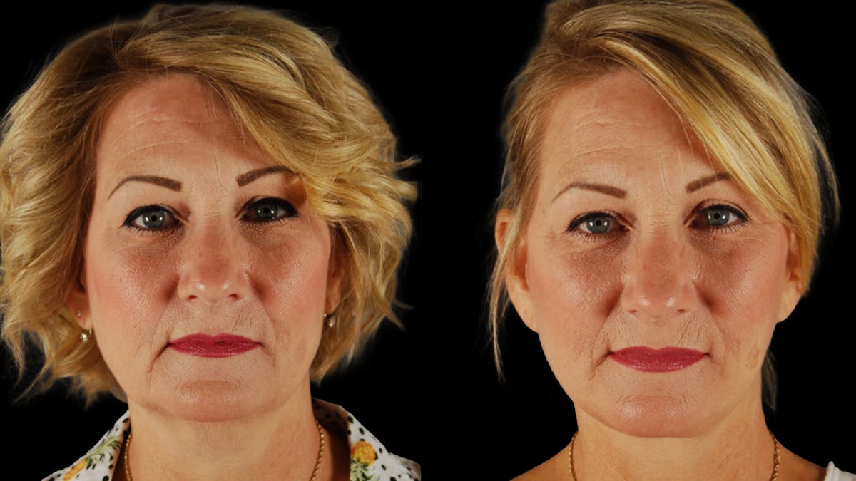 Deep Plane Facelift Before & After Gallery - Patient 294179 - Image 1