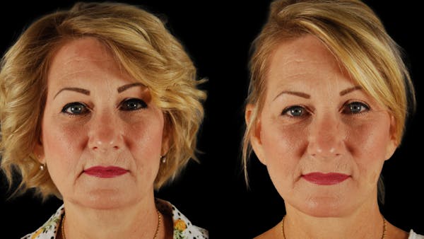 Neck Lift Before & After Gallery - Patient 263905 - Image 1