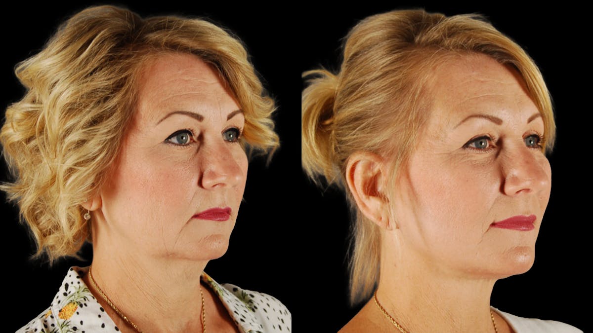 Deep Plane Facelift Before & After Gallery - Patient 294179 - Image 2