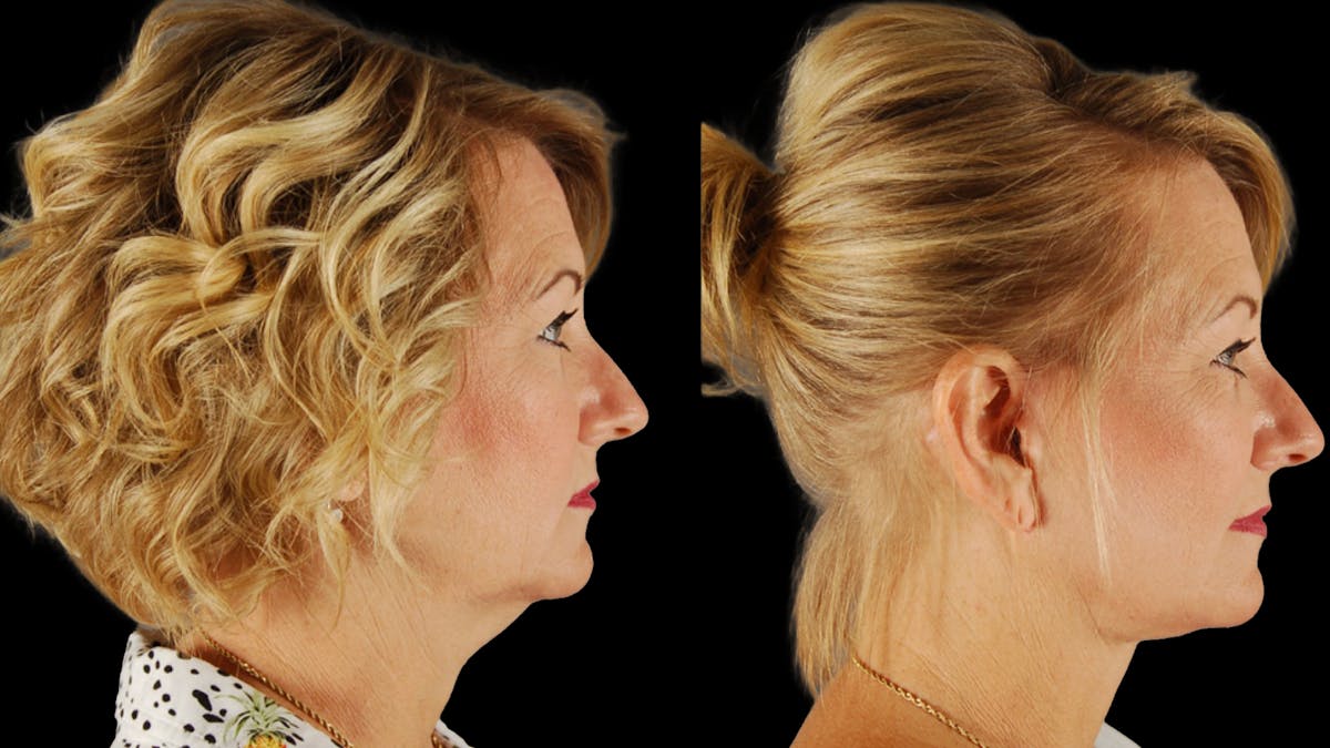 Deep Plane Facelift Before & After Gallery - Patient 294179 - Image 3
