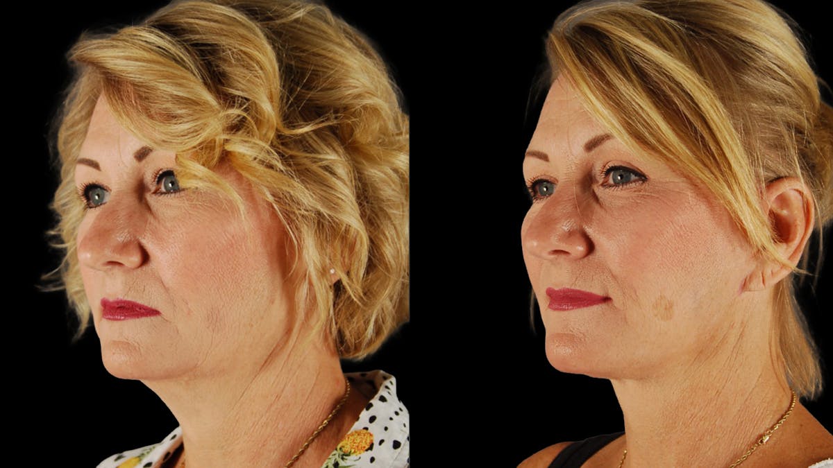 Deep Plane Facelift Before & After Gallery - Patient 294179 - Image 4