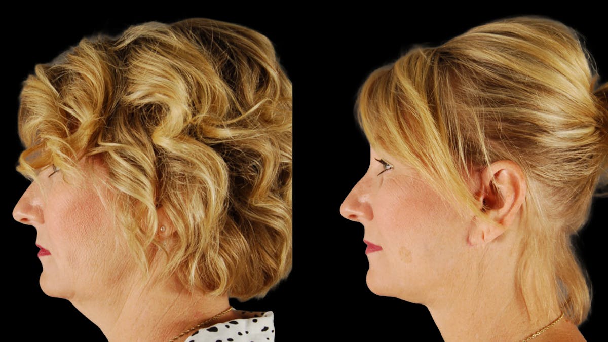 Deep Plane Facelift Before & After Gallery - Patient 294179 - Image 5