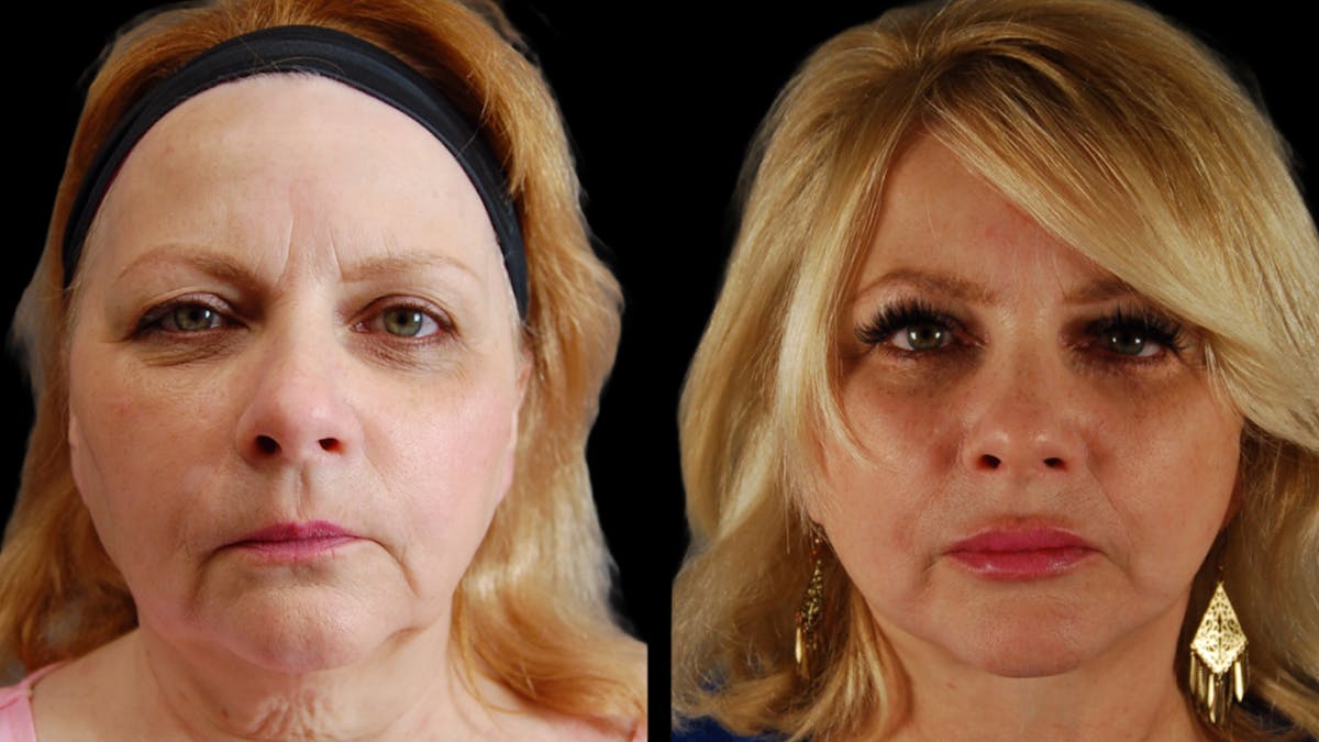 Neck Lift Before & After Gallery - Patient 139105 - Image 1