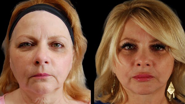 Neck Lift Before & After Gallery - Patient 139105 - Image 1