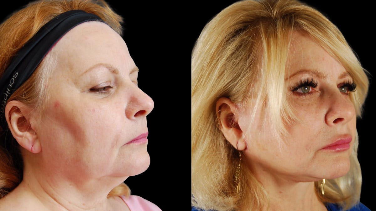 Neck Lift Before & After Gallery - Patient 139105 - Image 2