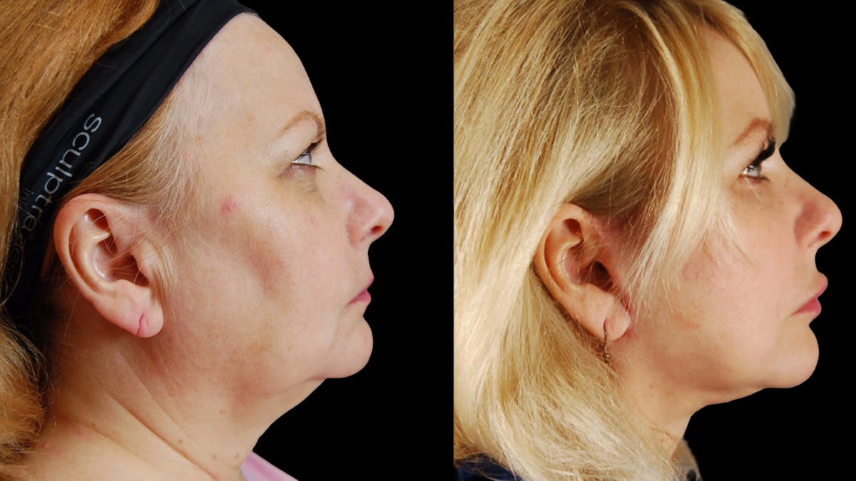 Neck Lift Before & After Gallery - Patient 139105 - Image 3