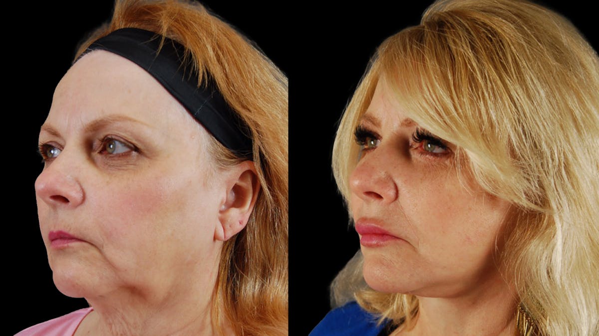 Neck Lift Before & After Gallery - Patient 139105 - Image 4
