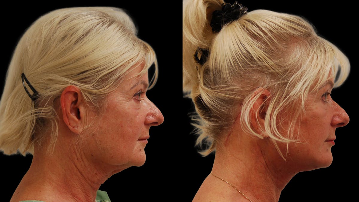 Deep Plane Facelift Before & After Gallery - Patient 131517 - Image 2