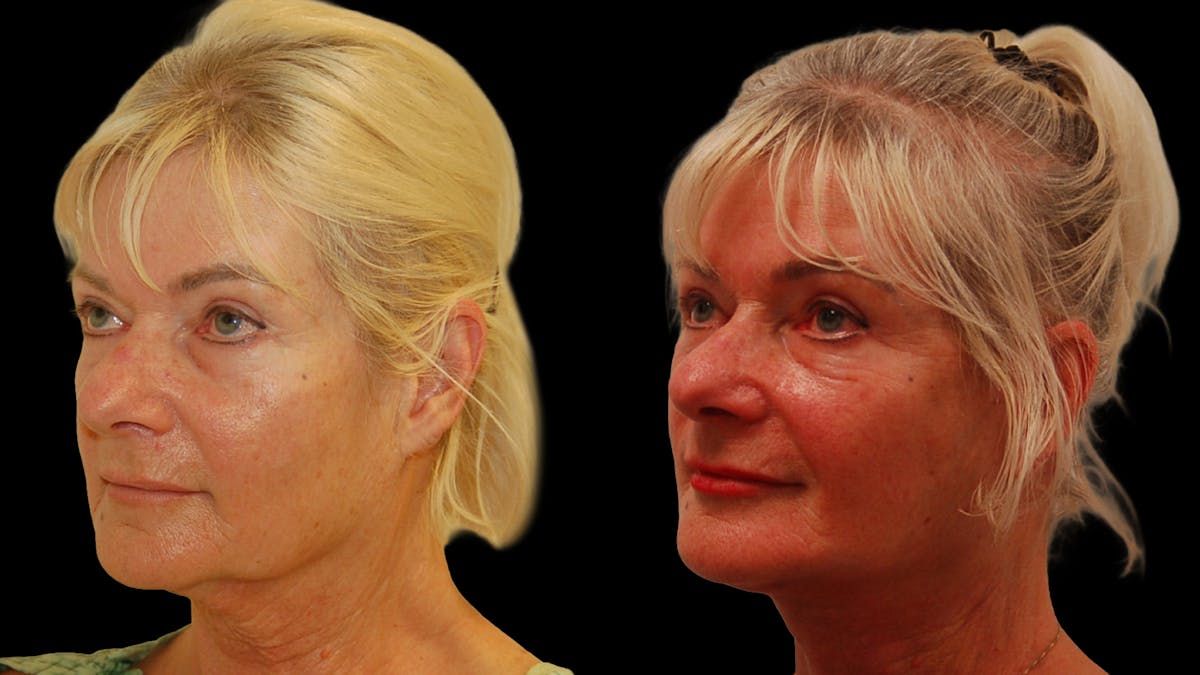 Deep Plane Facelift Before & After Gallery - Patient 131517 - Image 3