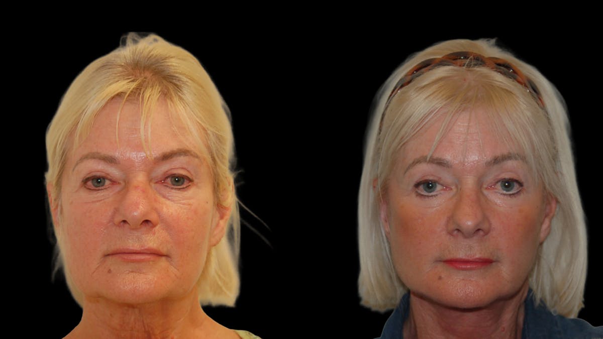 Deep Plane Facelift Before & After Gallery - Patient 131517 - Image 1