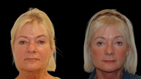 Neck Lift Before & After Gallery - Patient 373533 - Image 1