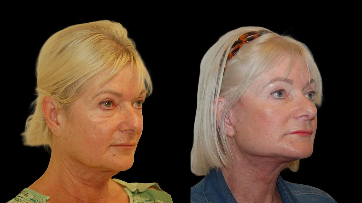 Deep Plane Facelift Before & After Gallery - Patient 131517 - Image 4