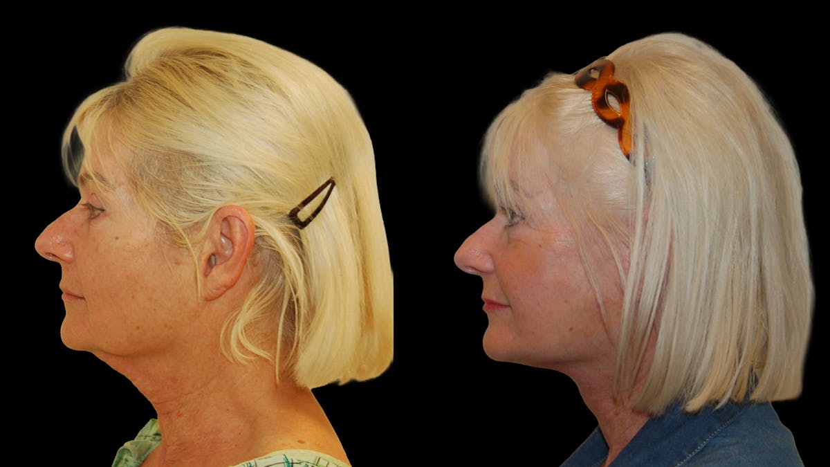 Deep Plane Facelift Before & After Gallery - Patient 131517 - Image 5