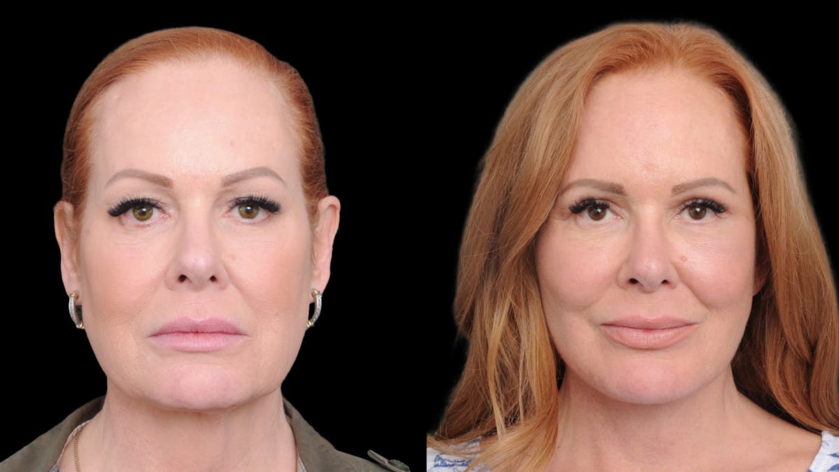 Deep Plane Facelift Before & After Gallery - Patient 573021 - Image 1