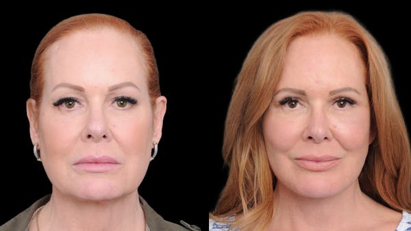 Deep Plane Facelift Before & After Gallery - Patient 573021 - Image 1