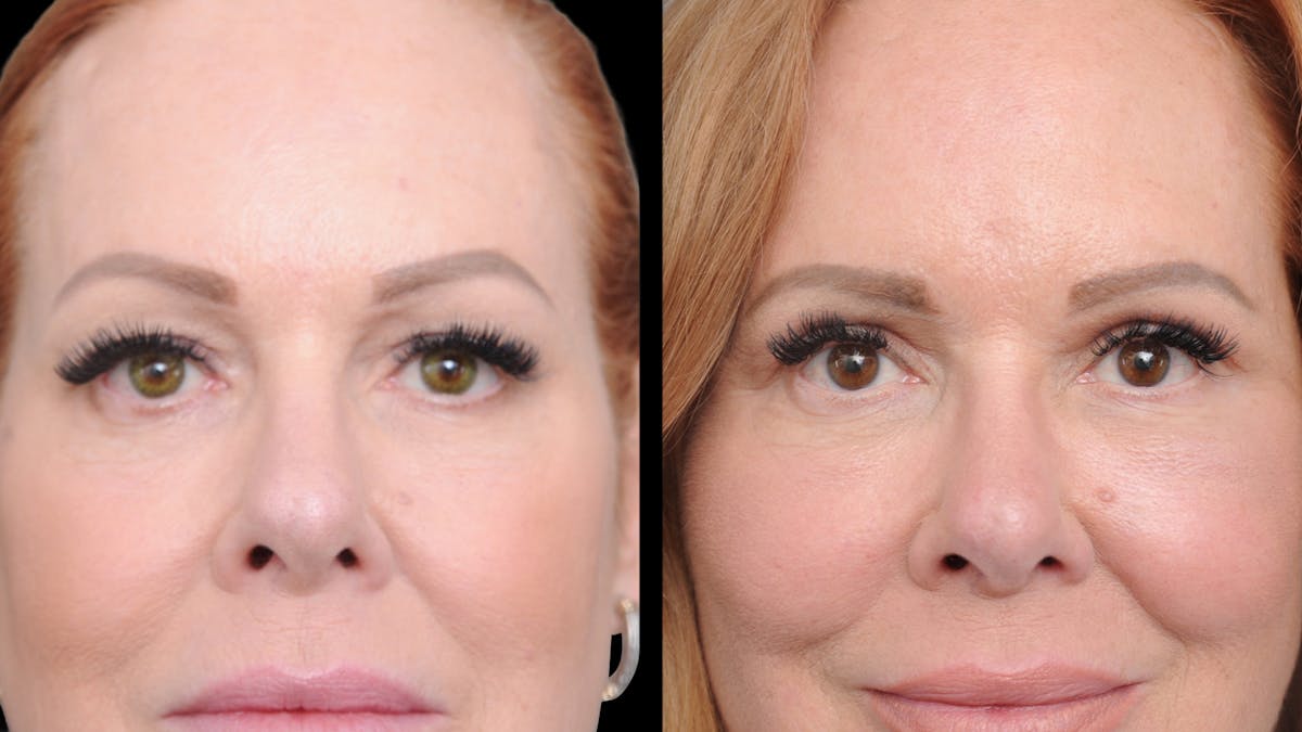 Deep Plane Facelift Before & After Gallery - Patient 573021 - Image 2