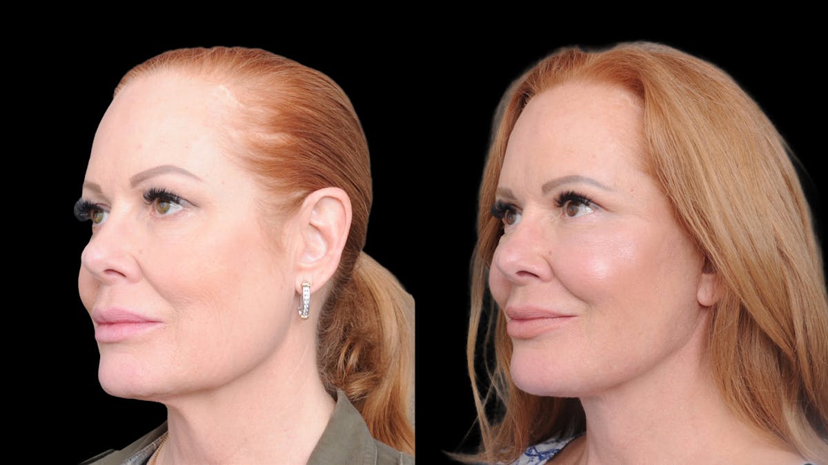 Deep Plane Facelift Before & After Gallery - Patient 573021 - Image 3