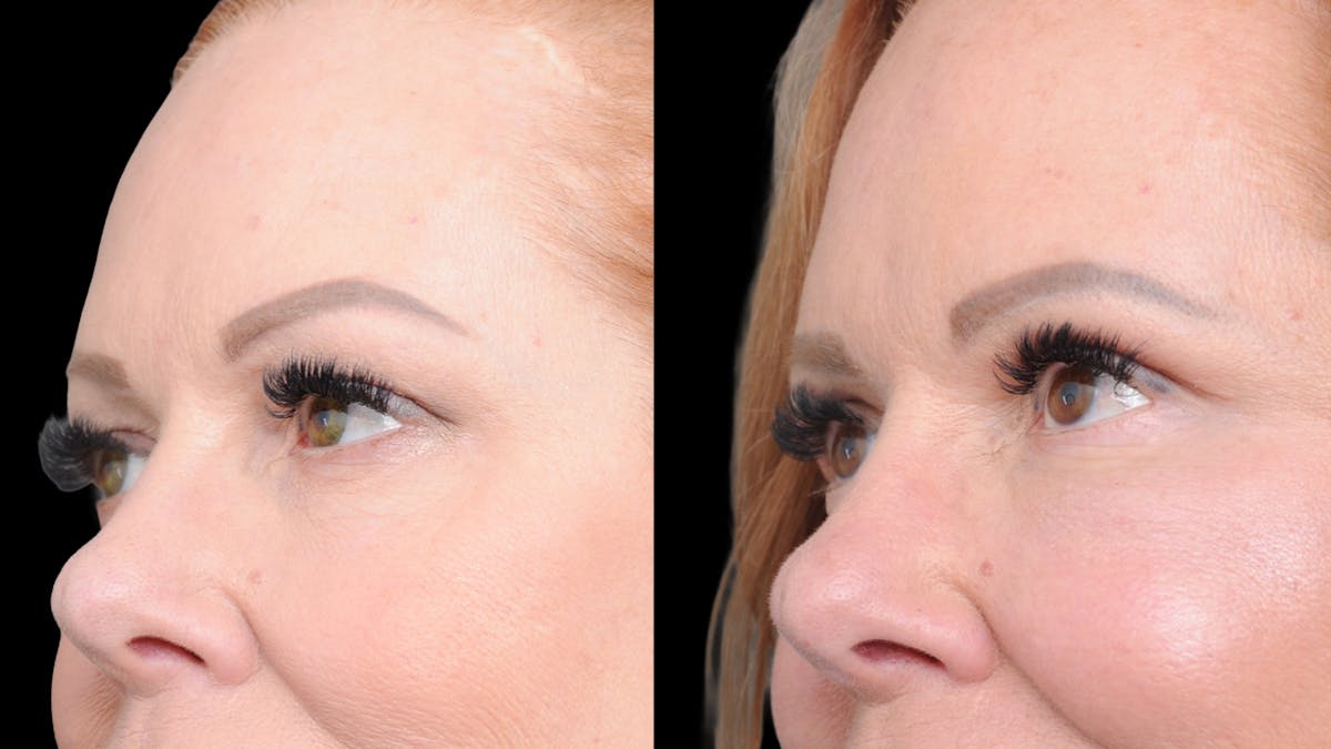 Deep Plane Facelift Before & After Gallery - Patient 573021 - Image 4
