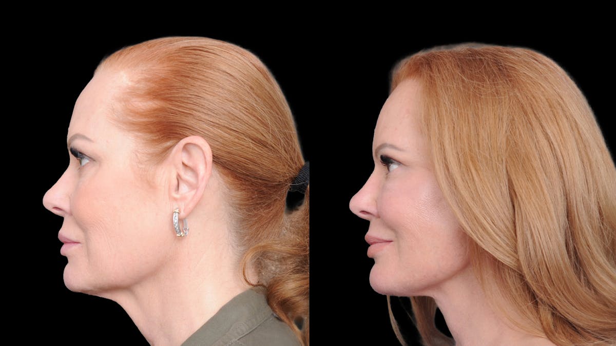 Deep Plane Facelift Before & After Gallery - Patient 573021 - Image 5