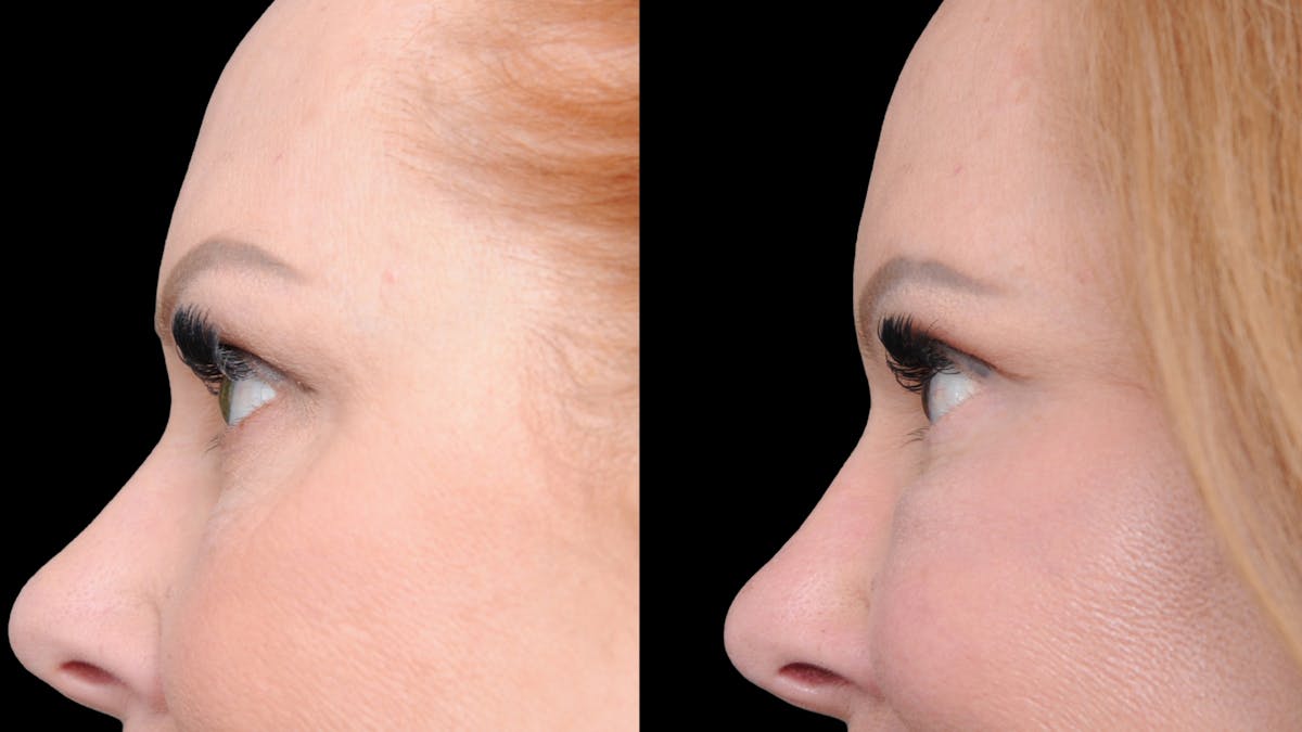 Deep Plane Facelift Before & After Gallery - Patient 573021 - Image 6
