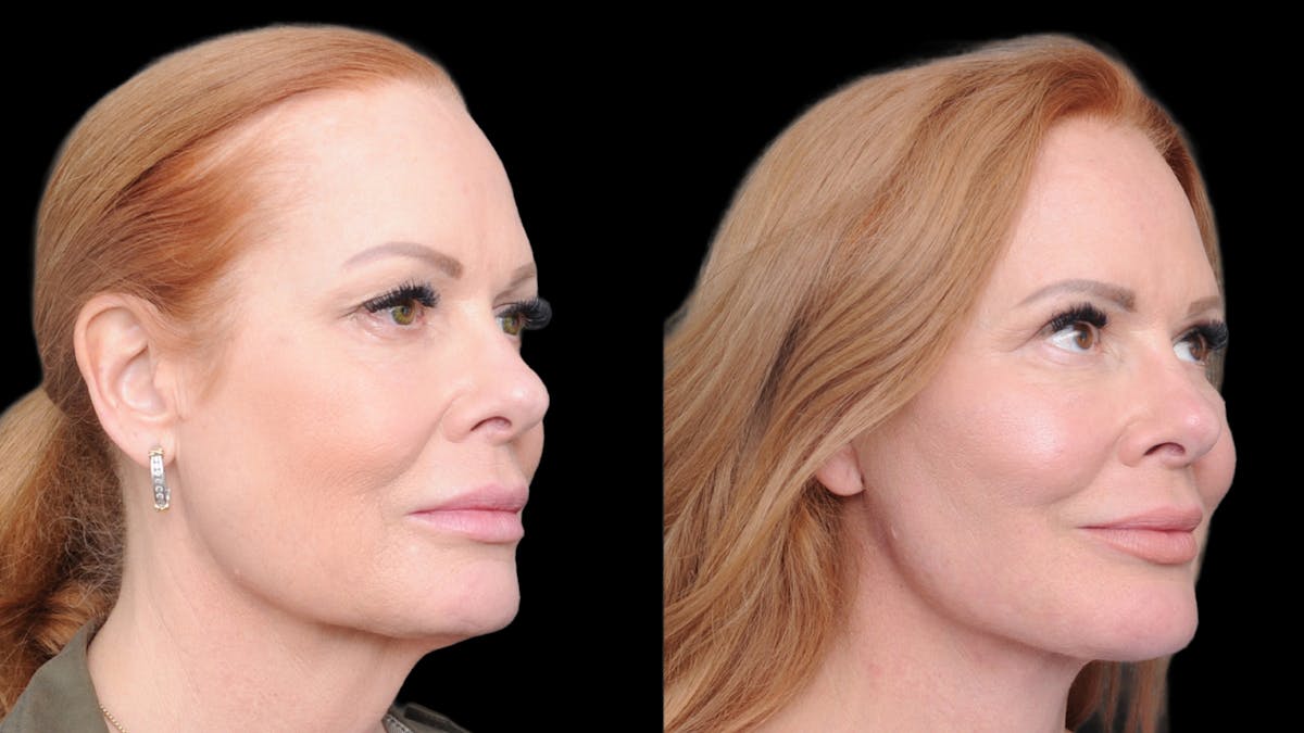 Deep Plane Facelift Before & After Gallery - Patient 573021 - Image 7