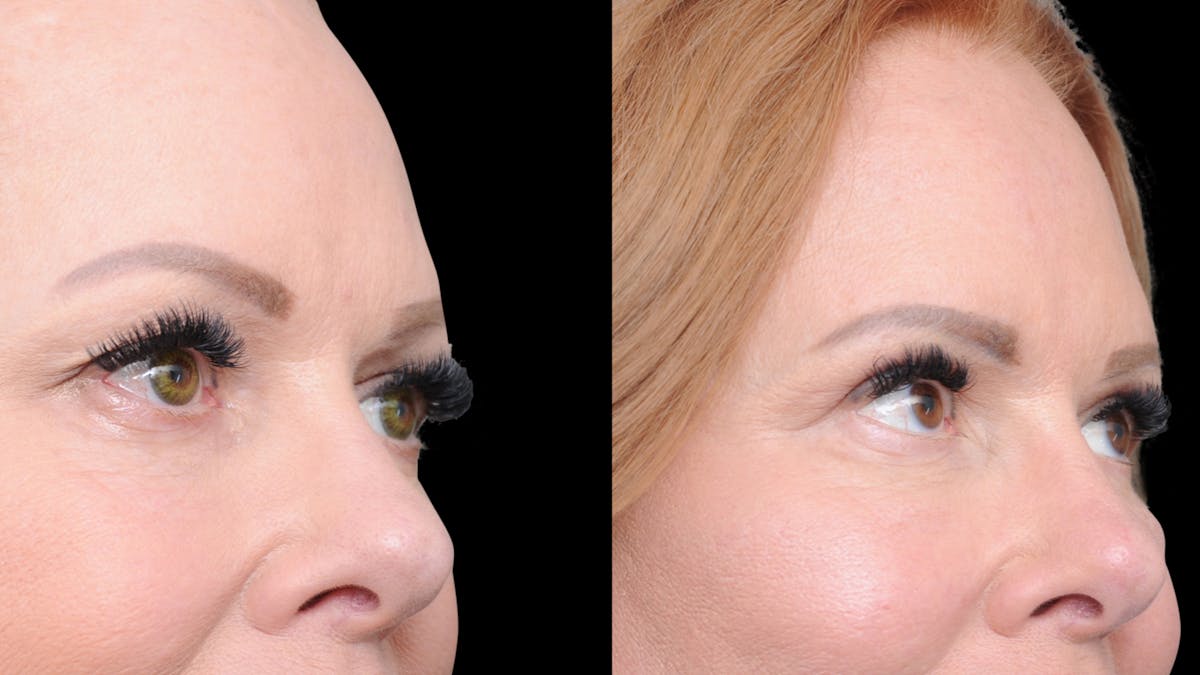 Deep Plane Facelift Before & After Gallery - Patient 573021 - Image 8