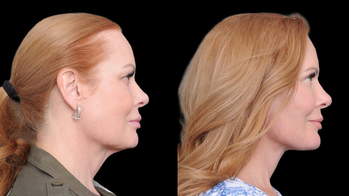 Deep Plane Facelift Before & After Gallery - Patient 573021 - Image 9