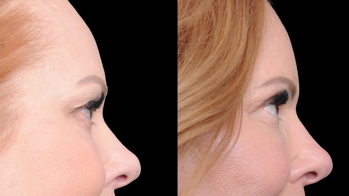Deep Plane Facelift Before & After Gallery - Patient 573021 - Image 10