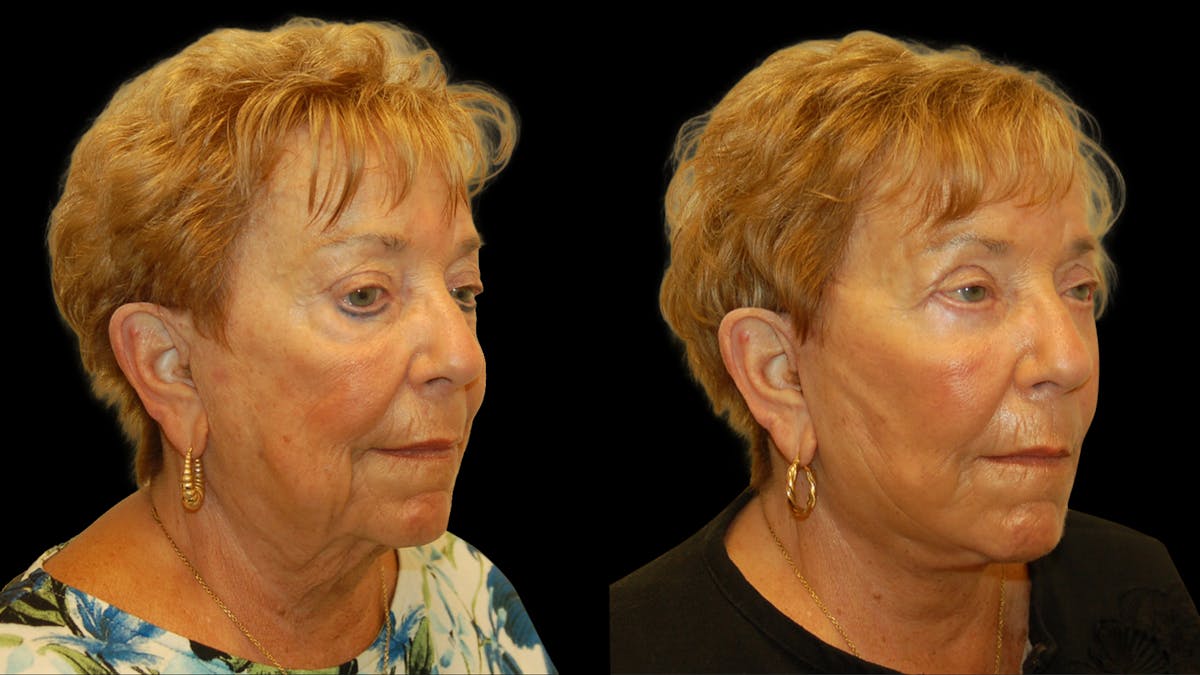 Deep Plane Facelift Before & After Gallery - Patient 213575 - Image 2