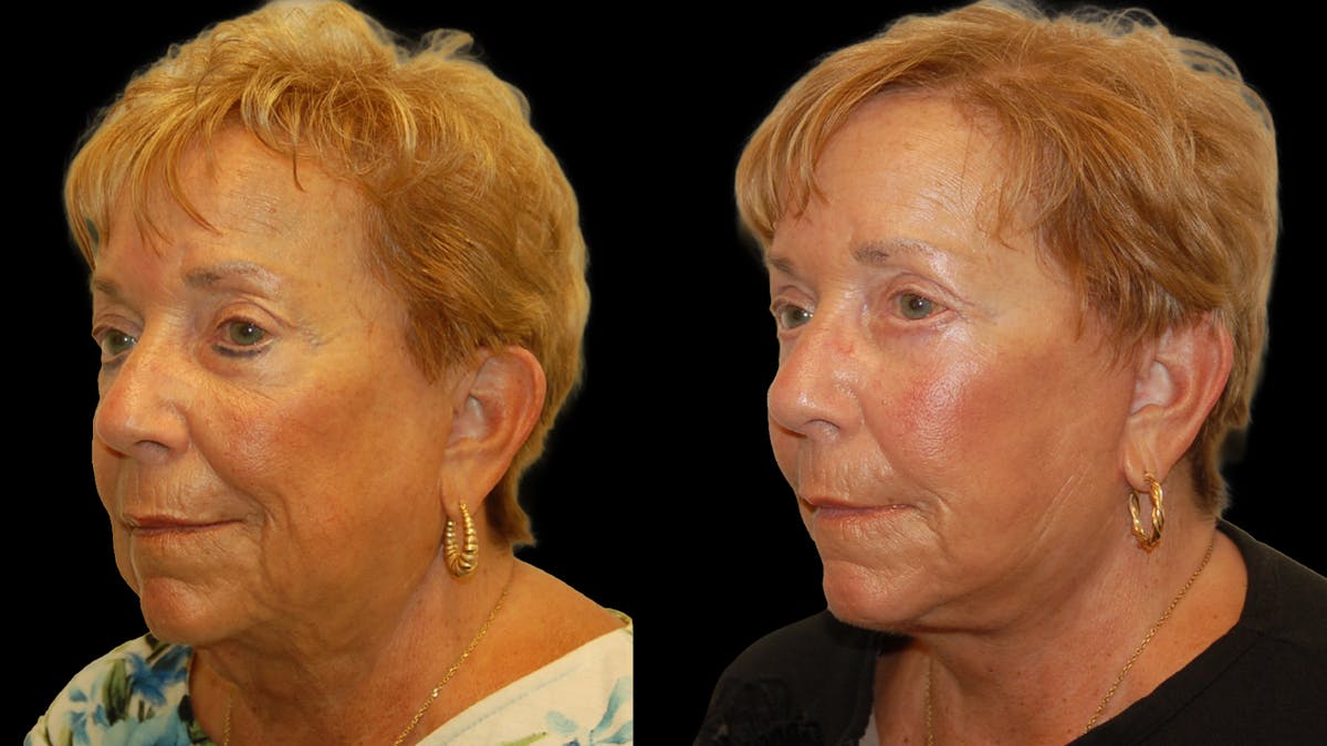 Deep Plane Facelift Before & After Gallery - Patient 213575 - Image 3