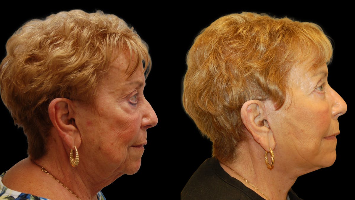 Deep Plane Facelift Before & After Gallery - Patient 213575 - Image 4