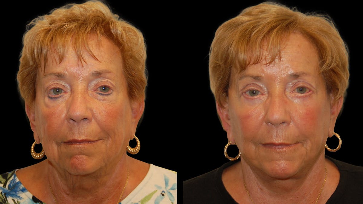 Deep Plane Facelift Before & After Gallery - Patient 213575 - Image 1