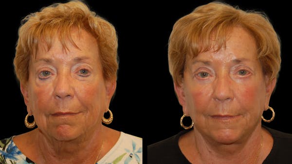 Neck Lift Before & After Gallery - Patient 382834 - Image 1