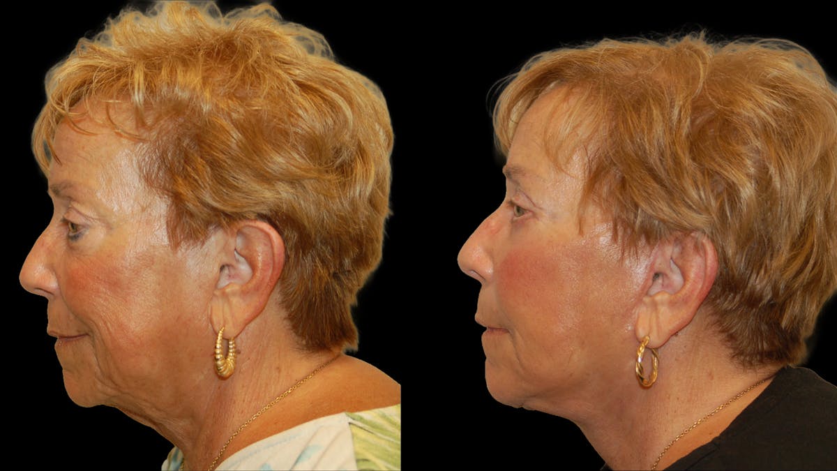 Deep Plane Facelift Before & After Gallery - Patient 213575 - Image 5