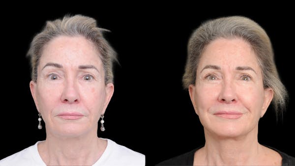 Neck Lift Before & After Gallery - Patient 292913 - Image 1