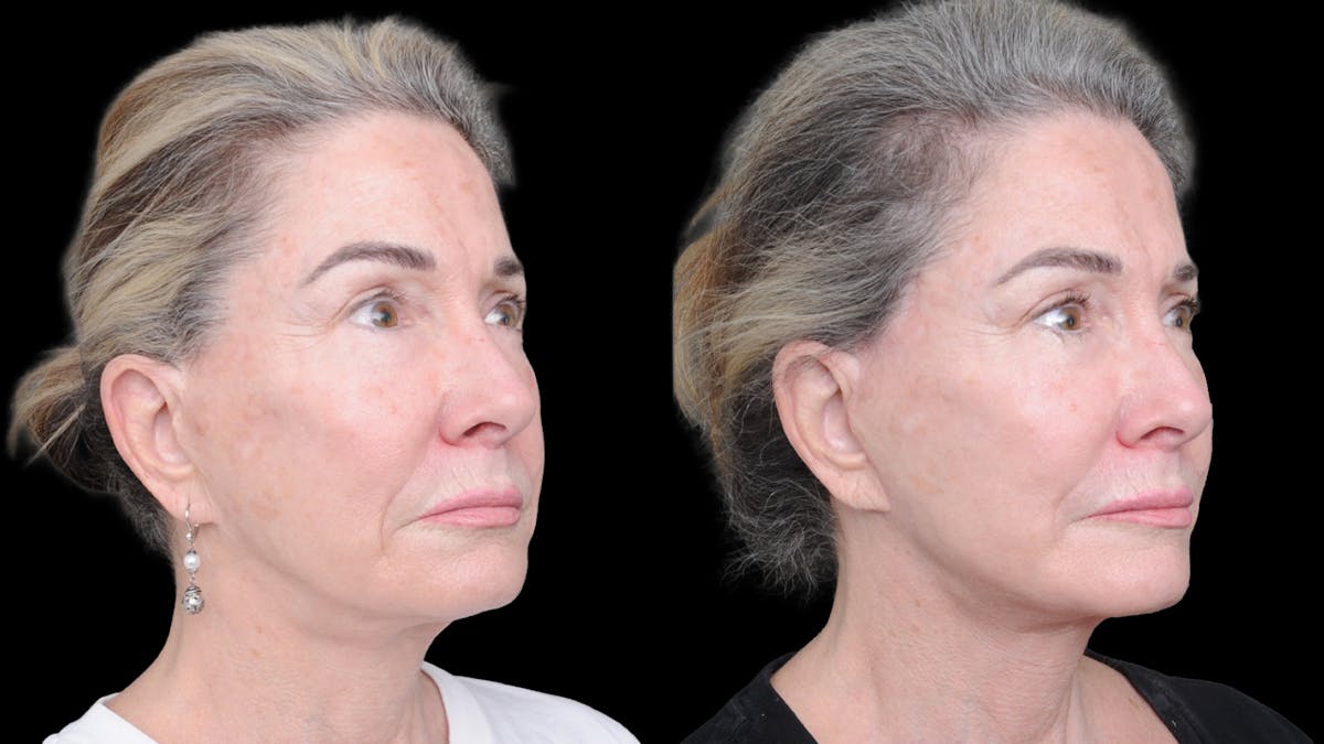 Deep Plane Facelift Before & After Gallery - Patient 309097 - Image 2