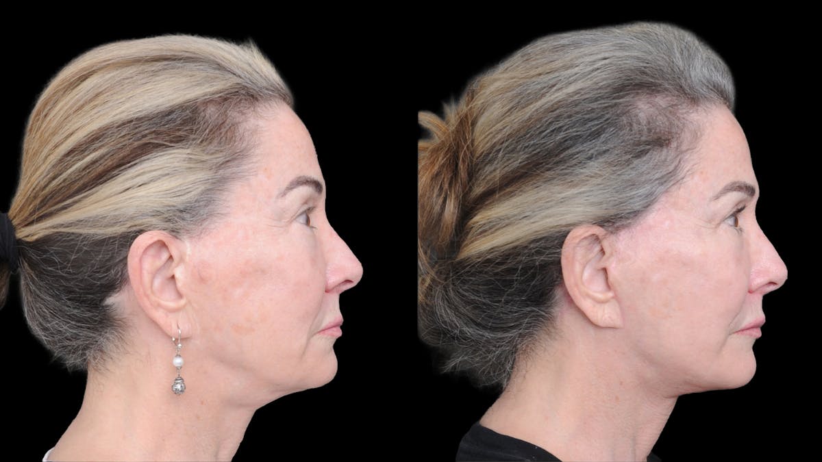 Deep Plane Facelift Before & After Gallery - Patient 309097 - Image 3