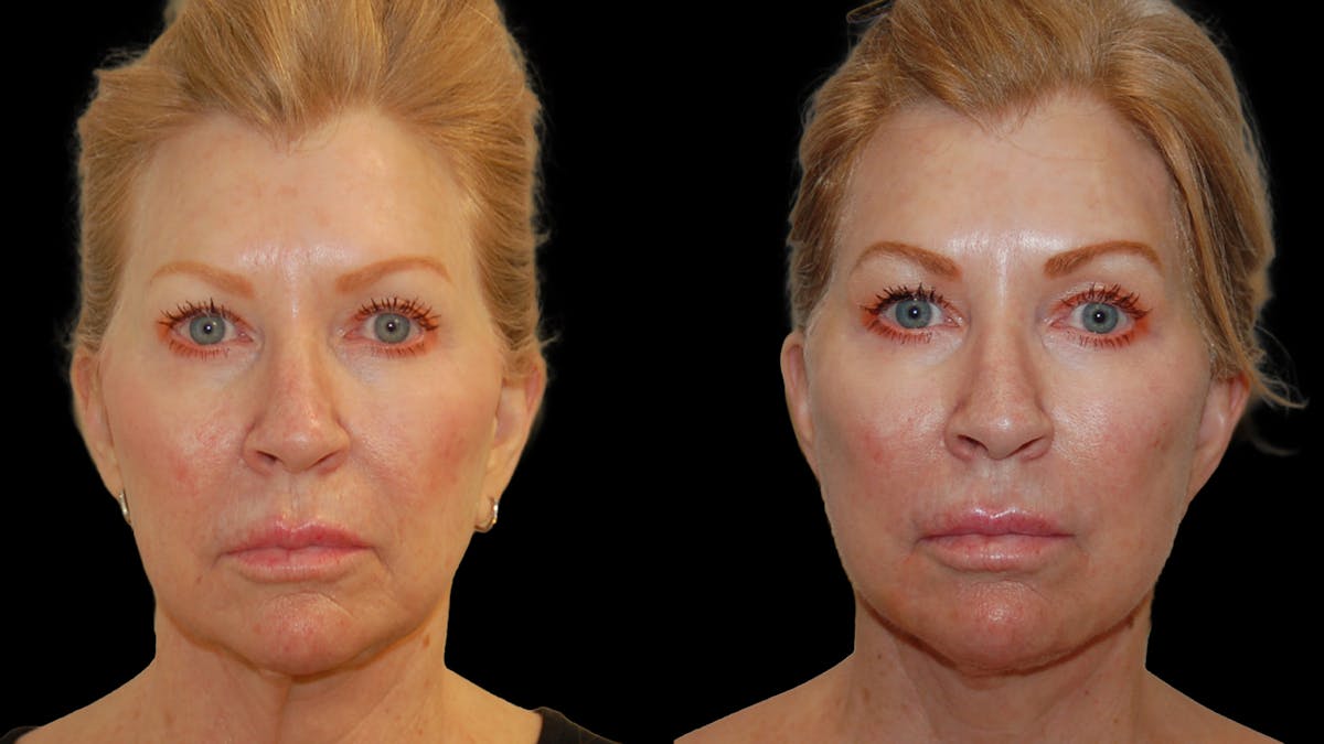 Deep Plane Facelift Before & After Gallery - Patient 326652 - Image 1