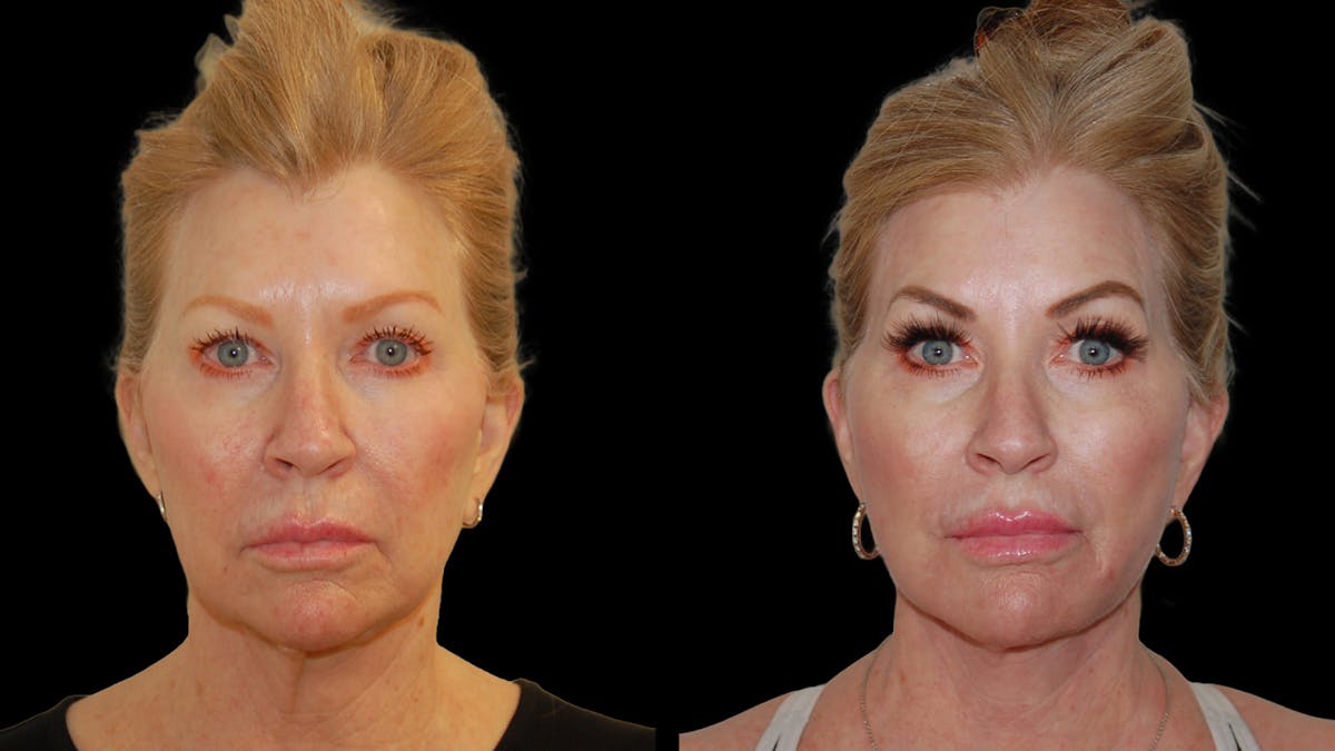 Deep Plane Facelift Before & After Gallery - Patient 326652 - Image 2
