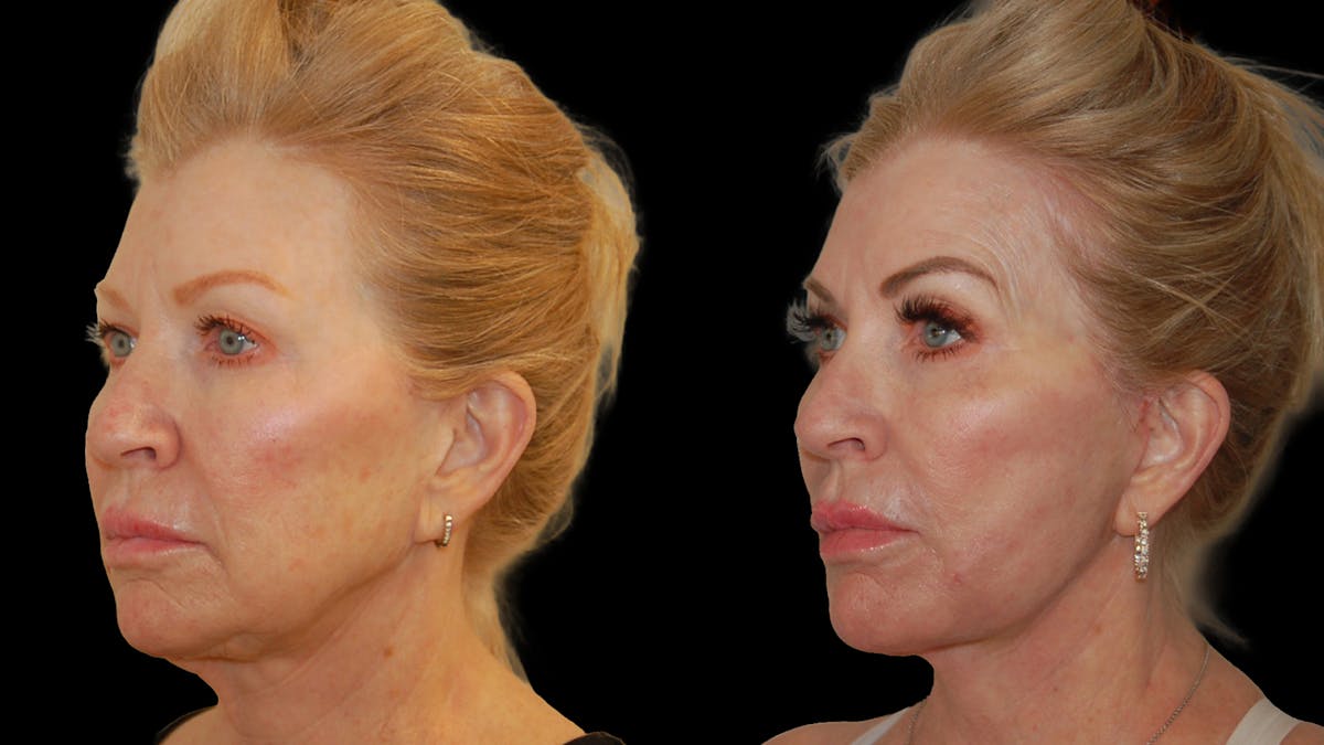 Deep Plane Facelift Before & After Gallery - Patient 326652 - Image 3