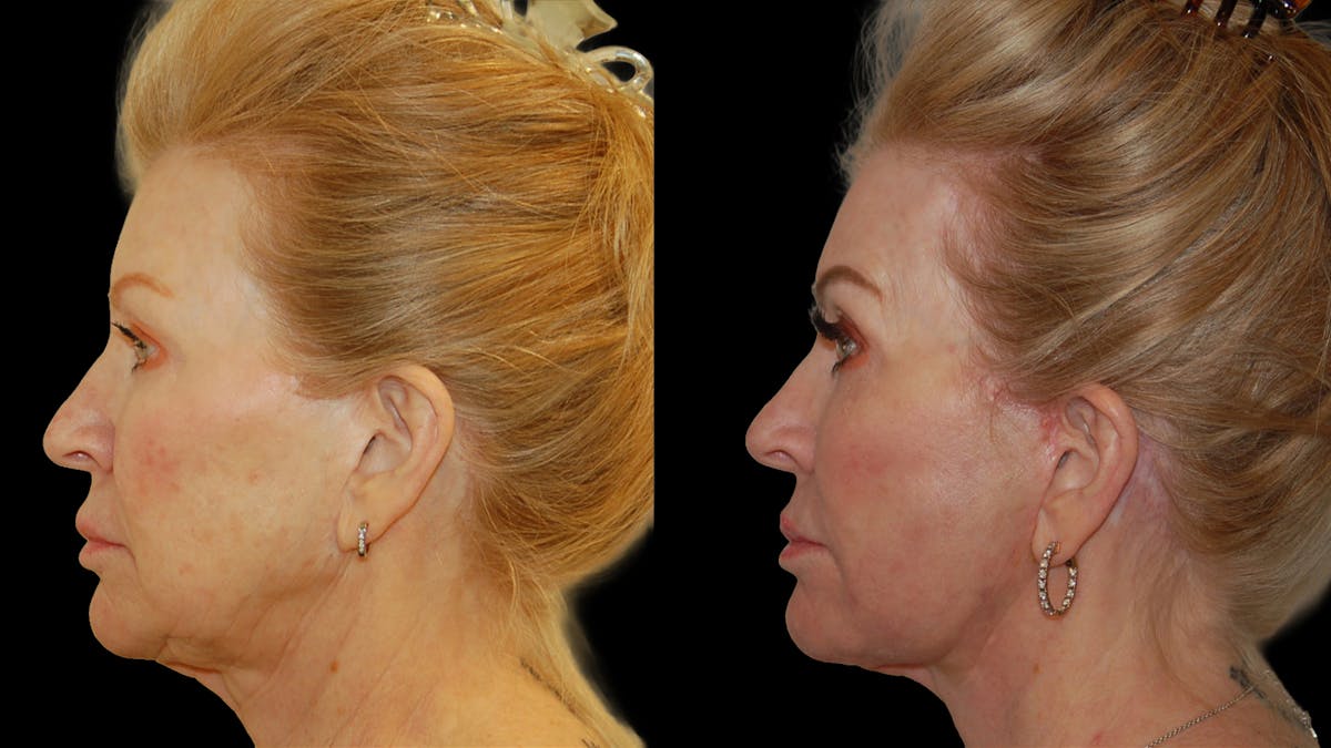 Deep Plane Facelift Before & After Gallery - Patient 326652 - Image 4