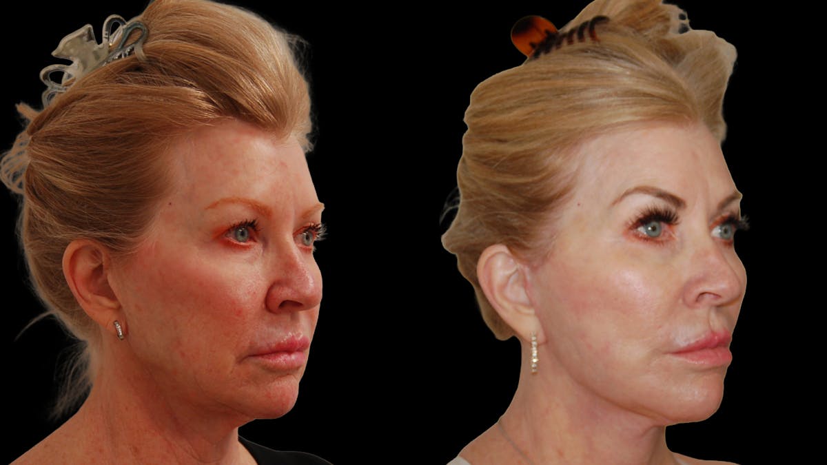 Deep Plane Facelift Before & After Gallery - Patient 326652 - Image 5