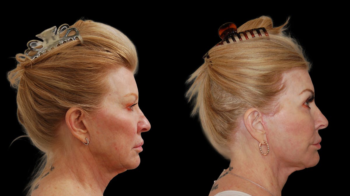 Deep Plane Facelift Before & After Gallery - Patient 326652 - Image 6