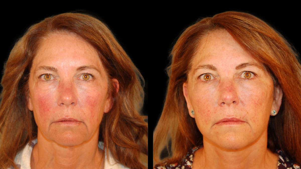 Deep Plane Facelift Before & After Gallery - Patient 222436 - Image 1